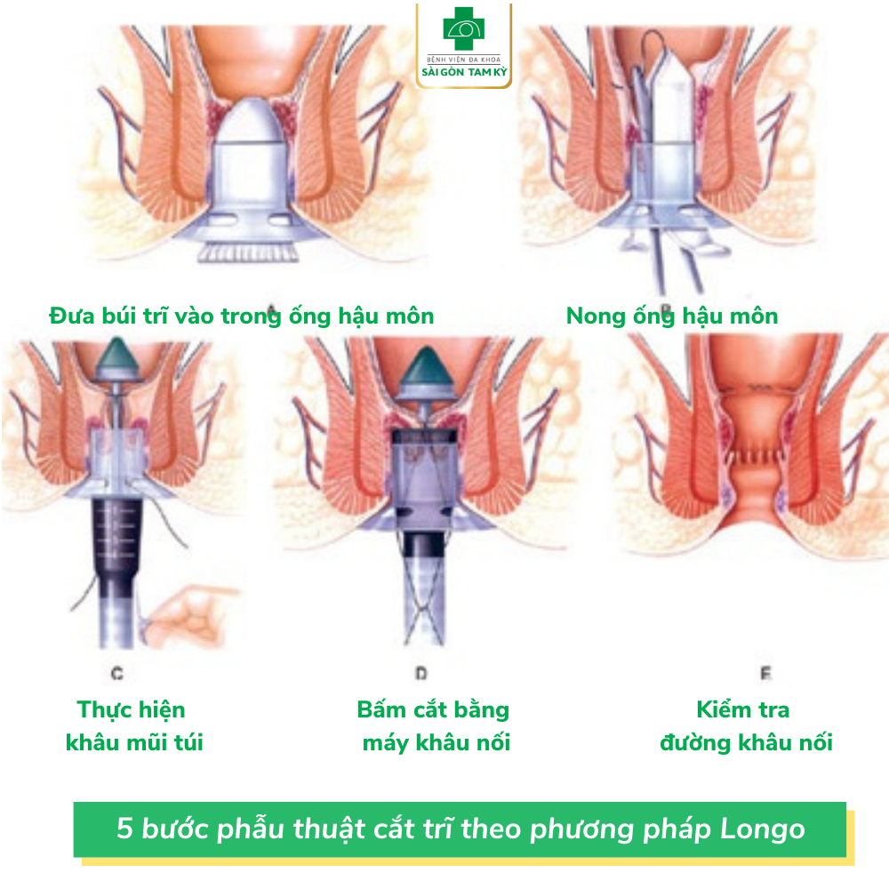 DÙNG PHƯƠNG PHÁP LONGO ĐIỀU TRỊ BỆNH TRĨ LÂU NĂM, TÁI PHÁT