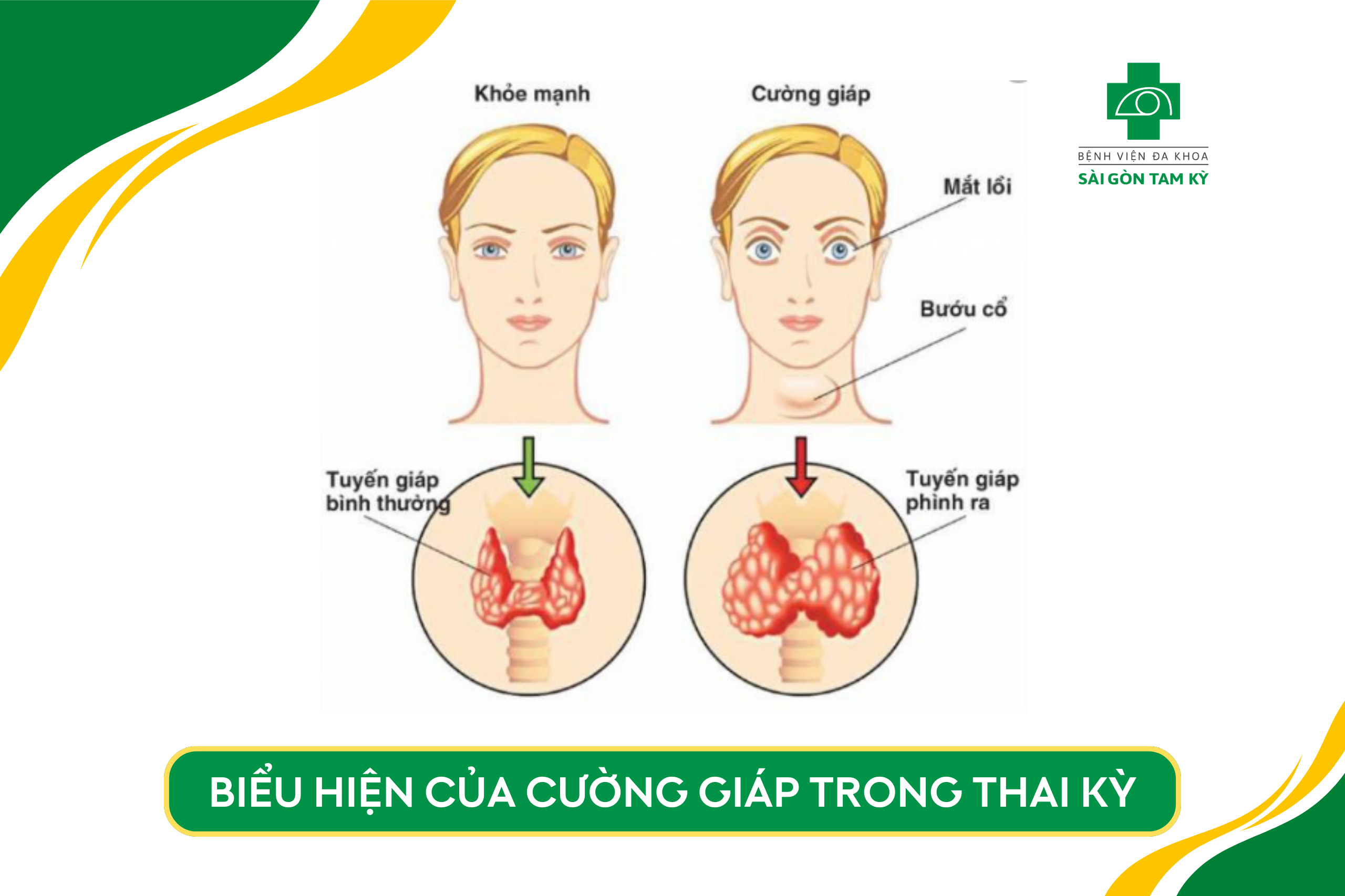 CÁCH LỰA CHỌN PHƯƠNG PHÁP ĐIỀU TRỊ CƯỜNG GIÁP TRONG THAI KỲ