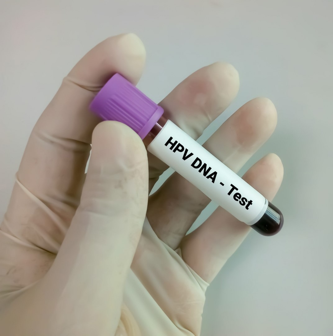 Lưu ý khi thực hiện và đọc kết quả xét nghiệm HPV DNA