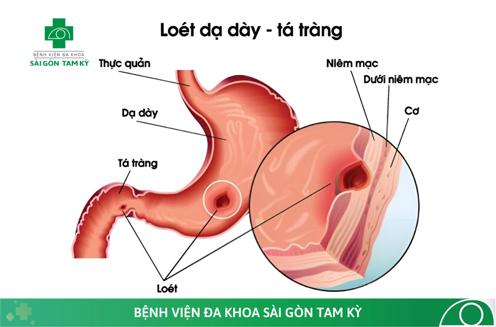 LƯU Ý CHĂM SÓC BỆNH LOÉT DẠ DÀY – TÁ TRÀNG SAU KHI XUẤT VIỆN