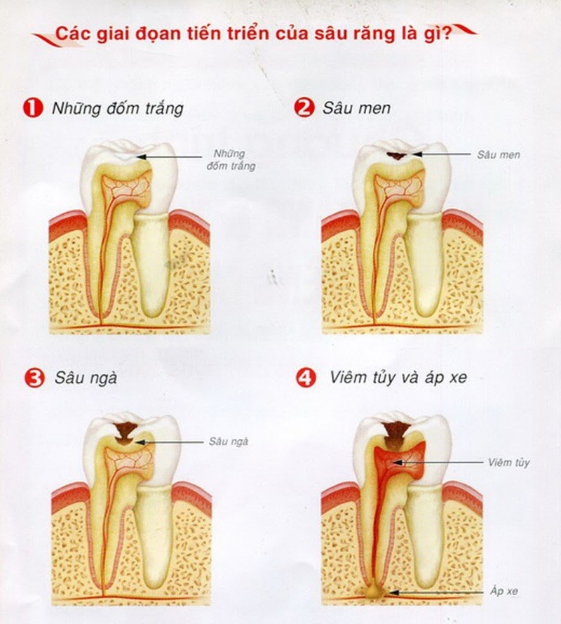 Răng sâu là tình trạng phổ biến, tuy nhiên bạn có biết cách tránh và điều trị sao cho tốt nhất? Xem hình ảnh về bệnh sâu răng để có thêm thông tin hữu ích.