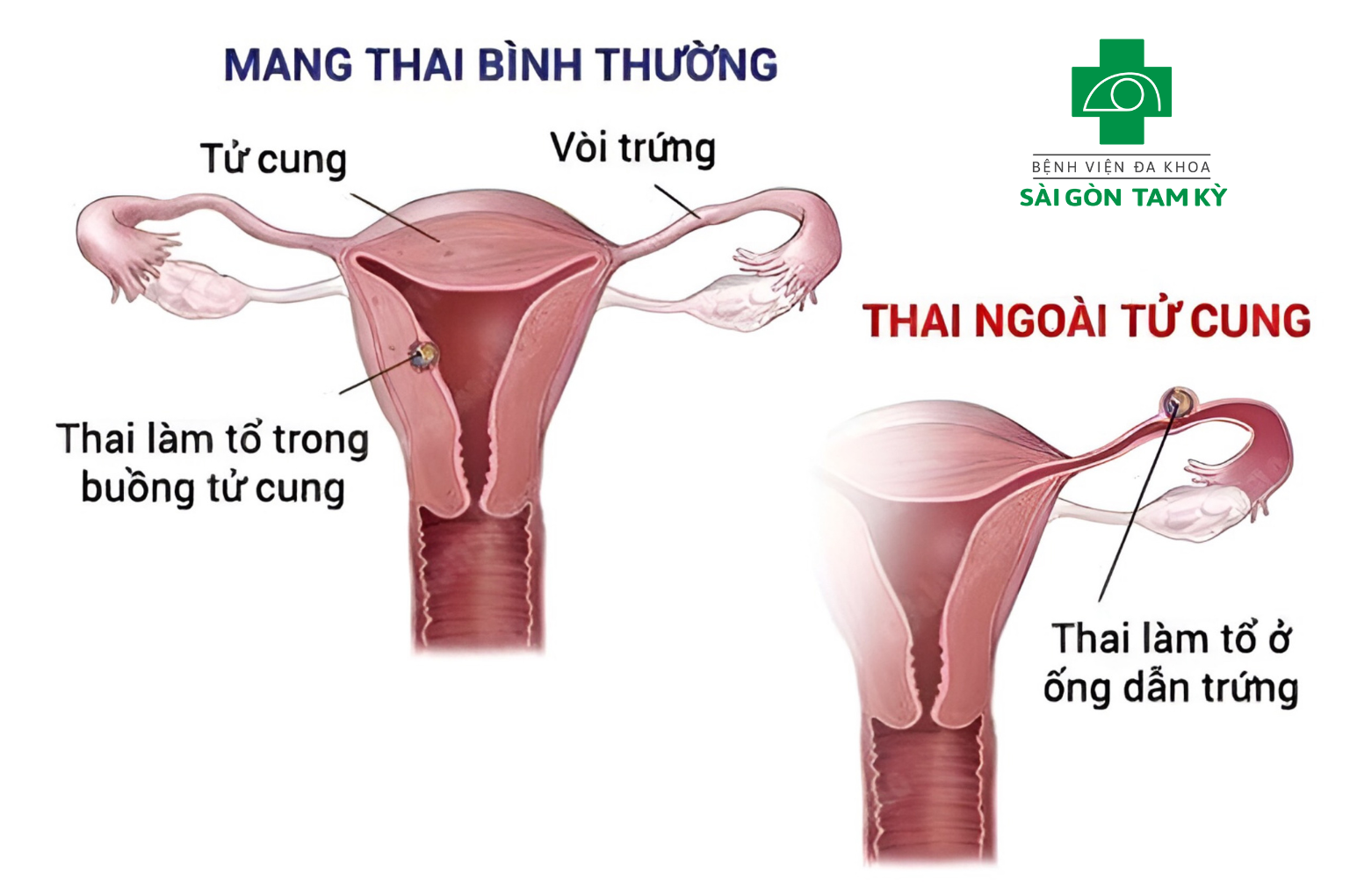 NHẬN BIẾT VÀ ĐIỀU TRỊ KỊP THỜI THAI NGOÀI TỬ CUNG