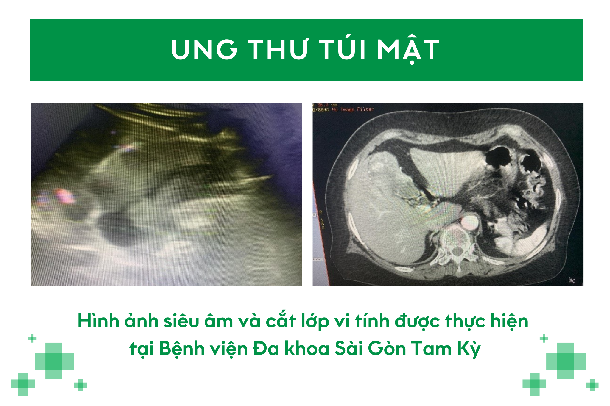 DẤU HIỆU NÀO ĐỂ NHẬN BIẾT UNG THƯ TÚI MẬT?